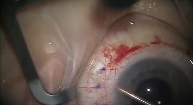 XEN Gel Stent Implantation in Combination with Laser-assisted Cataract Surgery