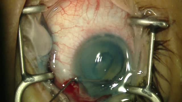 Hypermature Cataract With Assistance of a 27-Gauge Needle and ECP