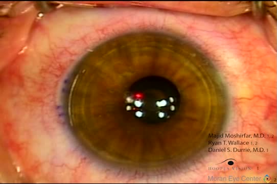 Simultaneous Photorefractive Keratectomy and KAMRA Inlay Procedures