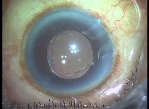 Stab Incision Glaucoma Surgery (SIGS) Live Surgery