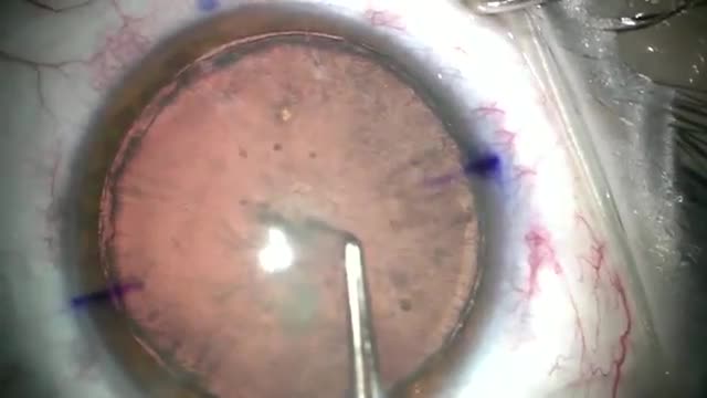CCC in a Patient with a Megalocornea