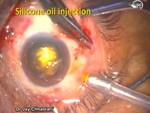 Bimanual Vitrectomy for Complicated Diabetic Combined Retinal Detachment