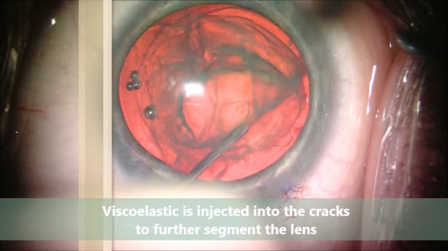 V-Slice Technique for Soft Lenses