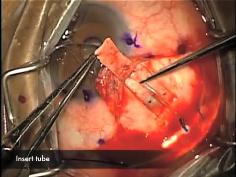 Supra-Tenons Baerveldt Glaucoma Drainage Device