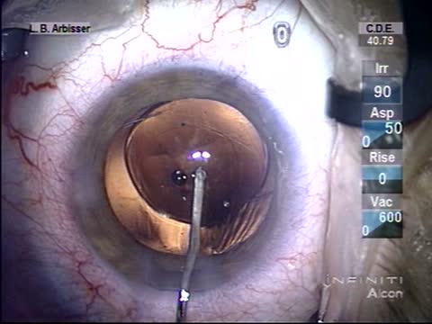 Bilateral Simultaneous Brunescent PCCC Optic Capture: Part 2