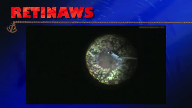 Scleral Fixated IOL