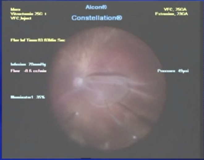 Retinal Fold