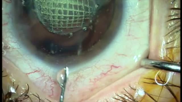 Femtosecond Laser Assisted Cataract Surgery Using Brody Femtosecond Dissecting Cannula