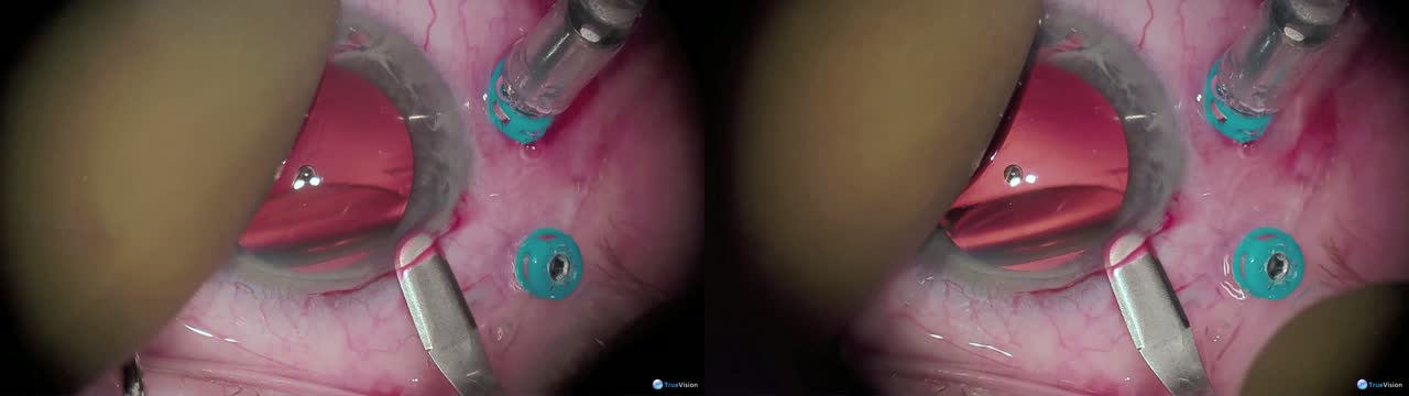 Transconjunctival PPV and Sutured PCIOL Placement: A Better Way 