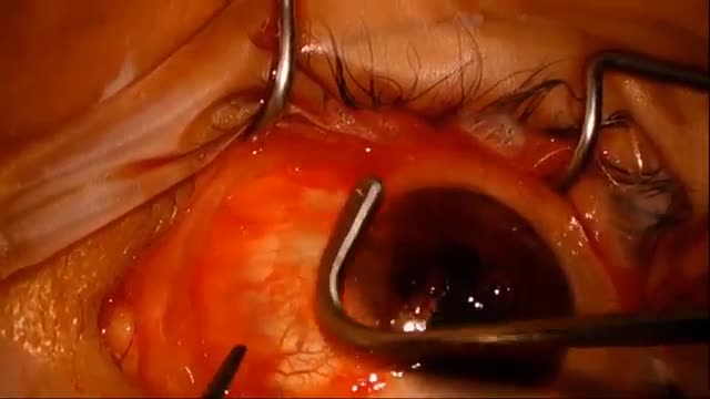 Recurrent Pterygium Managed with AmnioGraft and Tisseel Glue