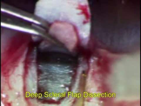 Non-penetrating Glaucoma Surgery Made Simple by Laser Assisted Deep Sclerectomy