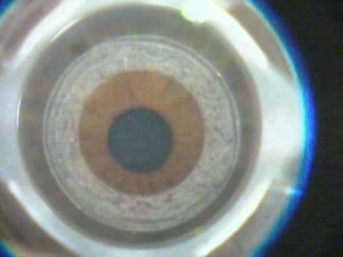 FEHLK: Femto Excimer Hybrid Lamellar Keratoplasy