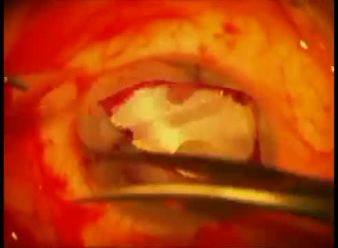 Tectonic Anterior Lamellar Keratoplasty for Corneal Perforation in PUK 