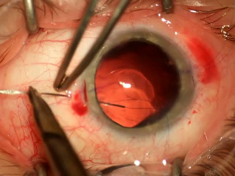 Dislocation of the Crystalline Lens to the Anterior Chamber