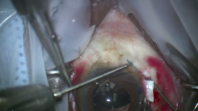 Anteriorly Dislocated IOL, Pars Plana Vitrectomy, Sutureless Intrascleral Fixated IOL