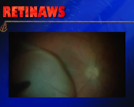 Macular Fold