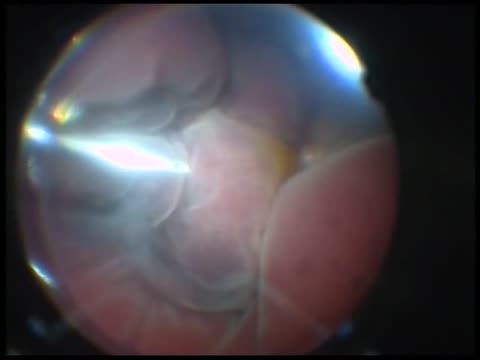 Subretinal Hemorrhage Surgery with 27-Gauge Instrumentation