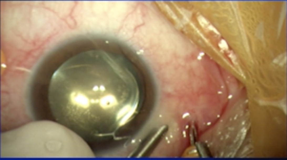 Sclerotomy Hemorrhage