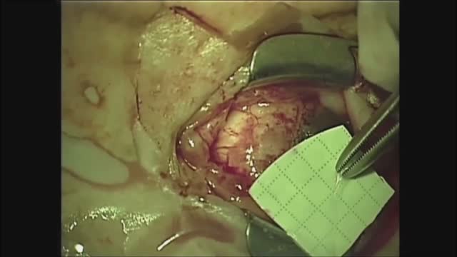 Recurrent Double Pterygium Surgery - Conjunctival and Amniotic Membrane Graft