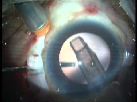Glued IOL During Live Surgery