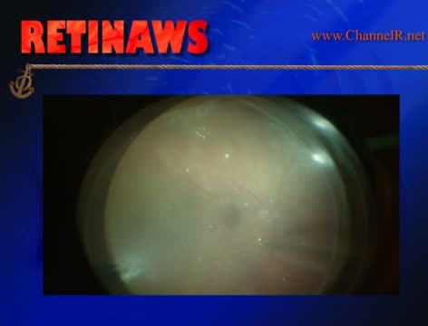 Submacular Hemorrhage