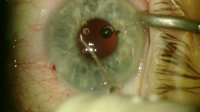 Small Pupil Phaco With iStent and ECP