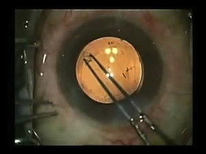 Ideal Capsulorrhexis
