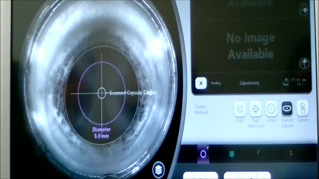 Capsulotomy Centration  