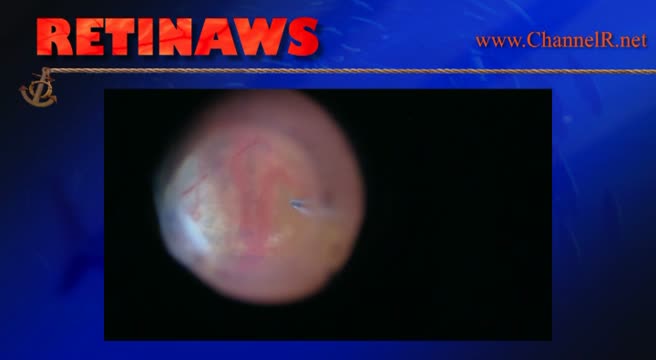 Thumbnail for isuwe