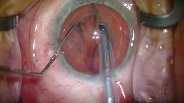 Traumatic Cataract and Pupil Reconstruction