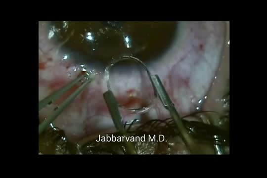 MyoRing Implantation in Corneal Ectasia Using Femtosecond Laser