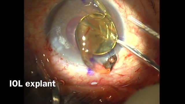 Astigmatism in a Postoperative Glaucoma Patient