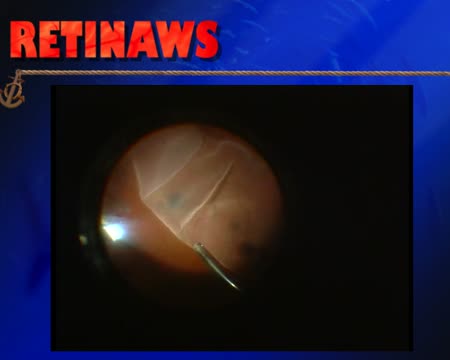 Giant Retinal Tear Detachment