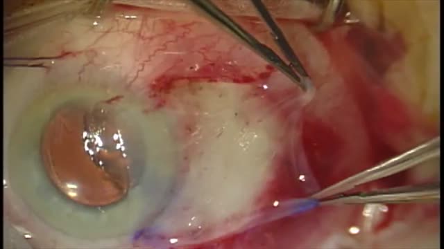 Pterygium Removal with Amniotic Membrane Graft