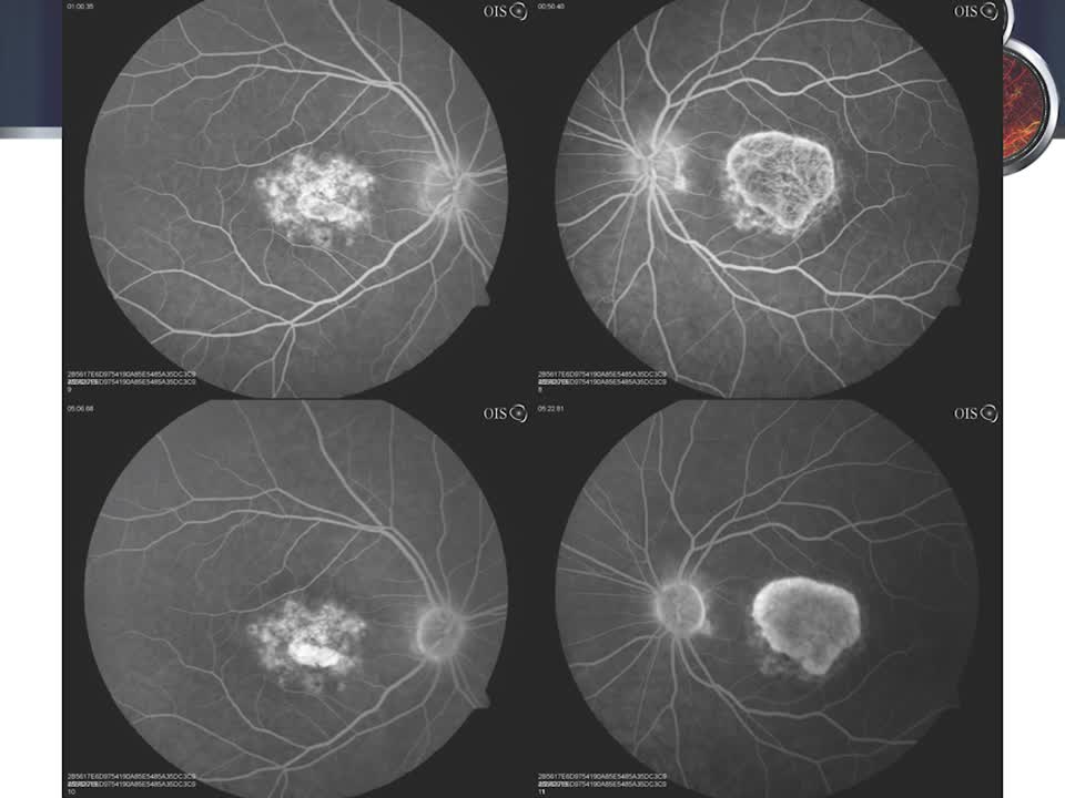 OCT Angiography in Stargardt Disease 