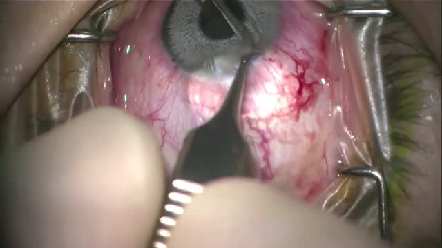 Modified Removal Technique for Bright Ocular Iris implants