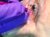 New MicroPulse&reg; P3 Device for Glaucoma Treatment