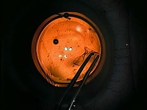Secondary Enlargement of Capsulorhexis
