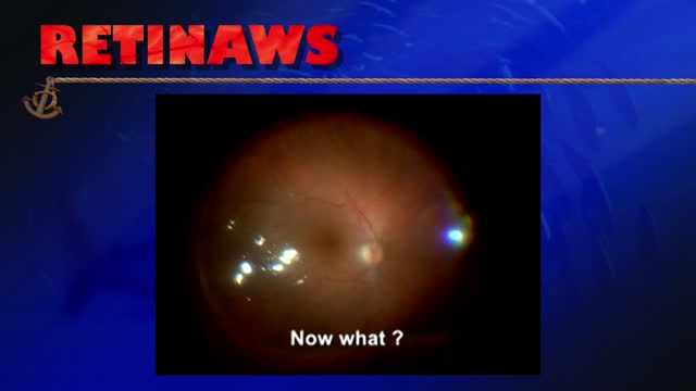 Macular Hole & Retina Detachment