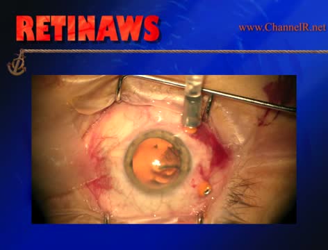 Trocar Insertion