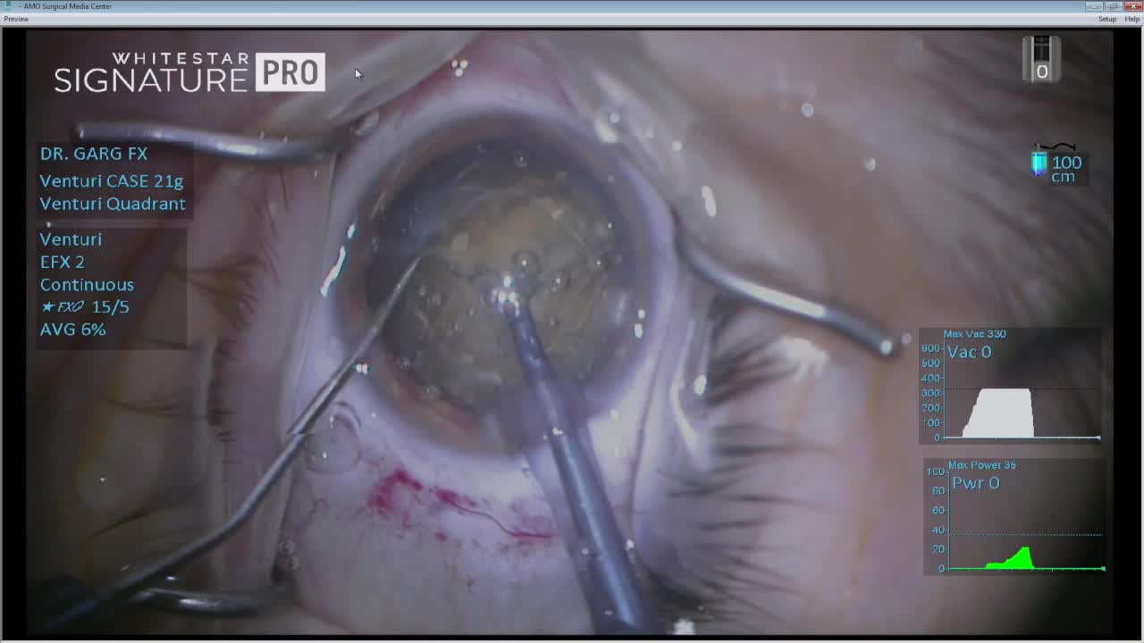 Dense Cataract with Catalys and WhiteStar Signature Pro