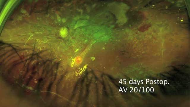 27 G + Bimanual Surgery on a Diabetic Retinal Detachment