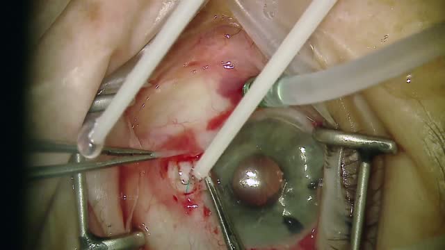 Glued IOL in Aphakic