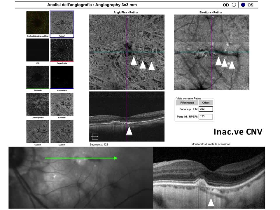 OCT-A Shows Association Between Perforating Scleral Vessels and CNV in Pathologic Myopia