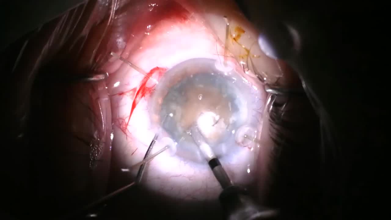 Brunescent Cataract and Sticky Capsule