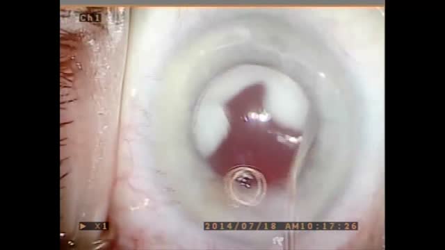 Dropless Cataract Surgery Series