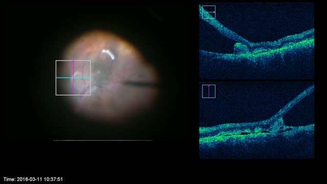 Intraoperative OCT in a Complex Retinal Detachment Case