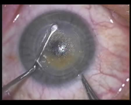 SMILE Procedure: Updated Technique