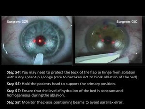 Standardization of LASIK Techniques