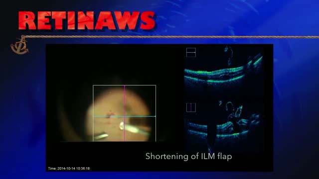Inverted ILM Flap Surgery 